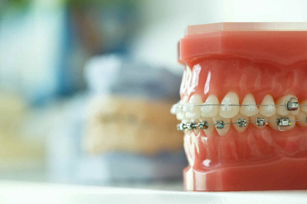 Boîtier orthodontique