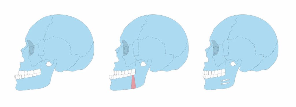 Chirurgie mâchoire